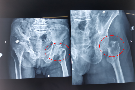 【厚德精医】广西胸科医院骨外科成功实施一例高龄高难度艾滋病骨科手术